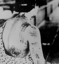 Hiroshima - Victims with Strange Burn Patterns