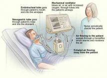 Elizabeth King - Breathing with a Ventilator