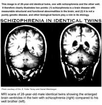 Schizophrenia in Identical Twins - Brain Scans